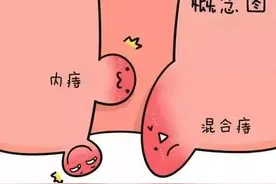 十人九痔？5个方法预防痔疮发作，不做“有痔之士”！图片