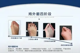 刷抖音刷到救星！微创术解决“大脚骨”图片