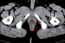 同学上课拿笔立凳子恶作剧，致男生肛门被笔戳破图片