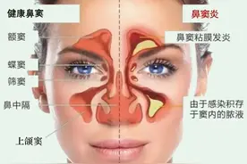 我的鼻窦炎手术经历图片