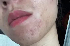 女性下巴长痘，10天后，痘痘几乎好了！图片