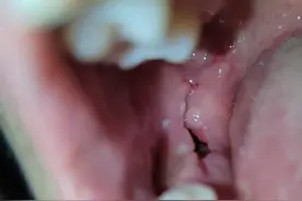 拔牙恢复期真可怕，🕳什么时候能长好图片