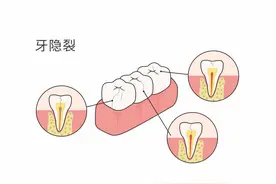 牙齿一咬就疼是怎么回事，该怎么办?图片