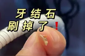 “牙结石”可以自己抠掉吗？教你几招，牙缝脏东西或能轻松掉图片