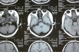 27岁女子面部发作性剧痛，查出脑内胆脂瘤——手术案例图片