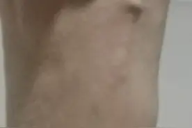 脚外踝撕脱性骨折一年图片