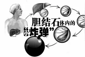 四川胆结石案例：小结石4年不管 疯长40倍变成“松花皮蛋”！图片