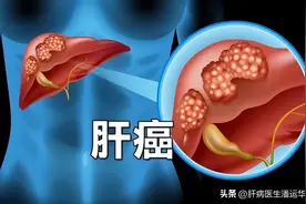 得了肝癌究竟能活多久？肝病专家跟你说实话！图片