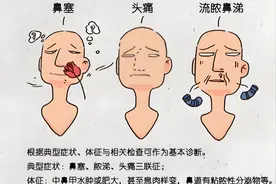 探秘鼻窦炎，守护鼻腔“防线”图片