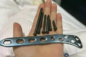 我用亲身经历带你了解胫腓骨拆取钢板钢钉的全过程，不紧张不恐怖图片