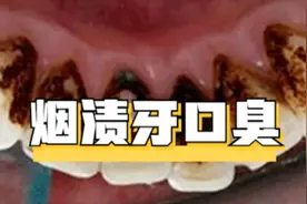 三个低成本方法去除满嘴黑臭烟渍！过来人的方法太神了！服气！图片