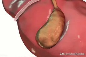 切除胆囊的人，后来怎么样了？看完这4种结果，你还敢切吗？图片