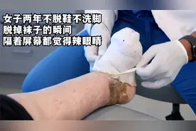 女子两年不脱鞋不洗脚，脱掉袜子的瞬间，隔着屏幕都觉得辣眼睛图片