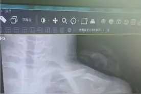 女子称儿子体胖跳绳慢，被体育老师体罚踹断锁骨；当地回应：警方立案调查，莒县教体局称涉事老师已被停职图片