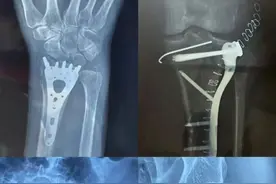 发生交通事故，哪些部位骨折可以达到10级伤残呢？图片