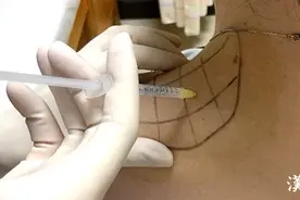 注射肉毒素导致不良反应，医生提醒，切勿贪图便宜！图片