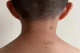 从小身上就有！以为是“胎记”，一查结果是肿瘤！图片