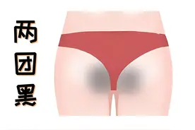 屁股后面的黑印子，原因、预防和祛除你有了解过吗？图片