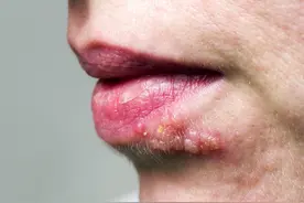 嘴起泡别乱擦药，平时常喝这3种汤，上火症状少复发图片