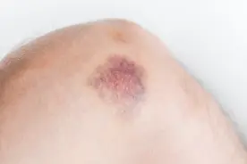 身上容易出现淤青 会是哪些原因导致的呢？一块来看看吧图片