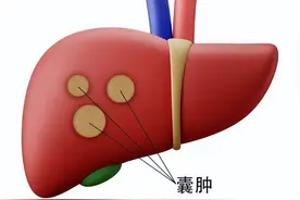 肝上有囊肿，要不要管？这种情况很危险，要警惕图片