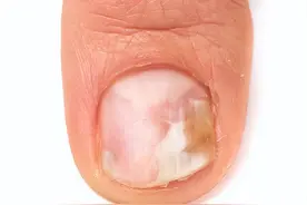 指甲上的月牙是健康的“晴雨表”？缺少月牙，或是3个原因而引起图片