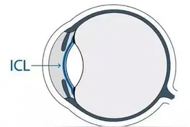 安全、稳定、可逆 ，一文读懂ICL晶体植入手术图片