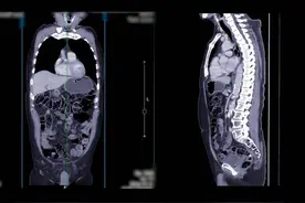 什么是冠脉造影？冠脉造影的危害有多大？本文一次说清图片