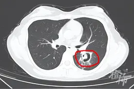 杭州00后姑娘高烧到40℃，肺部“发霉”！竟和清理衣柜有关……图片