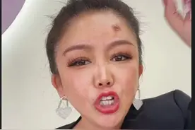 “苹果姐姐”整容失败。皮肤溃烂，精神崩溃，老公嫌弃。后悔死了图片