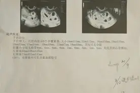 非常罕见！女子怀上9胞胎！医生：将减胎治疗，最多保2个图片