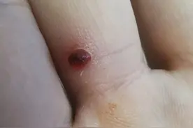 手指扎刺后长出个血色的小肉疙瘩，就像雨后破土而生的蘑菇图片