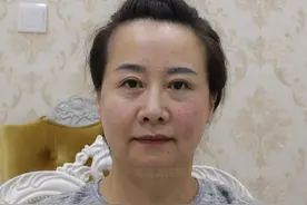 做完眼袋手术4年了，同大家坦白几点真相，不怕得罪医生！图片