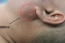 耳朵下面长了3公分的大包，究竟是什么？图片