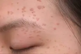 快速彻底剜除顽固性“扁平疣”的妙法，全在这里，不容错过图片