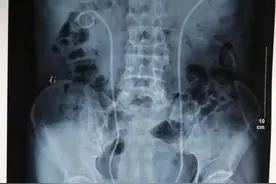 成都肾结石医院两分钟带你了解：泌尿结石术后，为啥要放“管子”图片