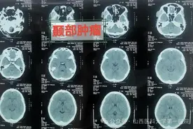 面侧部隆起肿块数年 竟是颞部血管瘤 山西医科大学第一医院成功实施手术图片