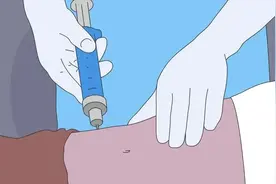 又一起！抽脂有风险，25岁女孩腹部抽脂永久丧失生育能力图片