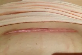 术后疤痕增生难淡化？剖腹产宝妈3个月祛疤经验分享，省钱高效！图片