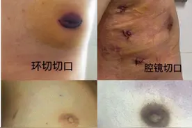 男性乳腺发育各术式一览——和你的期待一样吗！图片