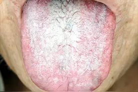 我们该如何从舌苔分析身体的健康状态?图片