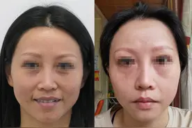 终于做了泪沟填充手术，瞅着多年轻啊！可不要小瞧这个手术图片