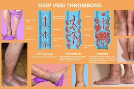 女工坐长途大巴回东莞返工，刚下车竟肺栓塞致心跳骤停？“经济舱综合症”不容小觑！图片