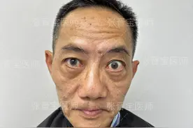 一趟上海，50分钟眼袋手术，15天恢复，60岁大哥直呼：就是年轻了图片