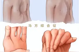 个子超高手指特长？警惕马凡综合征！图片