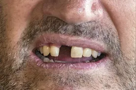 每天一个口腔小知识，今天说说什么是“固定义齿”？图片