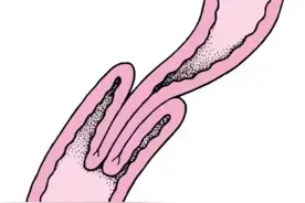 【妇幼特色】儿外科：守护稚嫩“生命线” 揭秘小儿肠套叠紧急救治图片