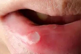 口腔黏膜白斑与溃疡：傻傻分不清？看这里就懂了图片