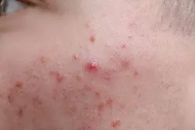 连翘败毒丸，皮肤感染首选中成药，清热解毒家庭常备药图片