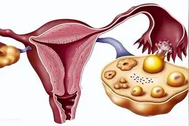 什么叫卵巢早衰？有什么症状呢？图片
